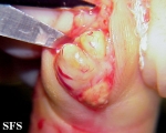tenosynovitis nodular