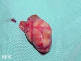 tenosynovitis nodular
