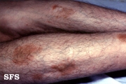 majocchi's disease