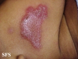 leprosy tuberculoid-nodular leprosy of childhood