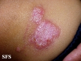 leprosy tuberculoid-nodular leprosy of childhood