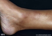 granuloma_annulare_subcutaneous