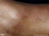 granuloma_annulare_subcutaneous
