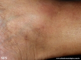 granuloma_annulare_subcutaneous