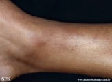 granuloma_annulare_subcutaneous
