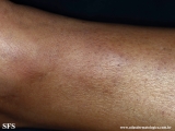 granuloma_annulare_subcutaneous