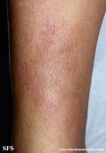 granuloma_annulare_subcutaneous