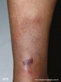 granuloma_annulare_subcutaneous