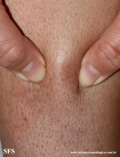 granuloma_annulare_subcutaneous