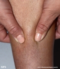 granuloma_annulare_subcutaneous
