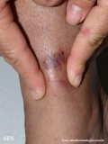 granuloma_annulare_subcutaneous