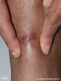 granuloma_annulare_subcutaneous