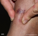 granuloma_annulare_subcutaneous
