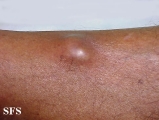 phaeohyphomycosis