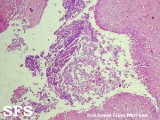 phaeohyphomycosis