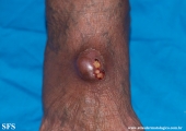 phaeohyphomycosis