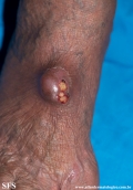 phaeohyphomycosis