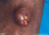 phaeohyphomycosis