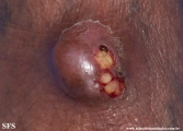 phaeohyphomycosis