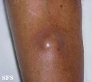 phaeohyphomycosis