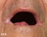 angular cheilitis
