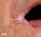 angular cheilitis