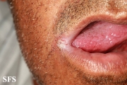angular cheilitis
