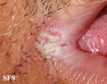 angular cheilitis