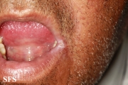 angular cheilitis
