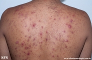 neutrophilic_eccrine_hidradenitis
