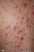 neutrophilic_eccrine_hidradenitis