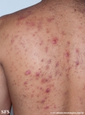 neutrophilic_eccrine_hidradenitis