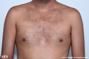 neutrophilic_eccrine_hidradenitis