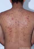 neutrophilic_eccrine_hidradenitis