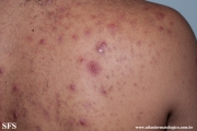 neutrophilic_eccrine_hidradenitis