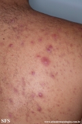 neutrophilic_eccrine_hidradenitis
