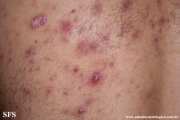 neutrophilic_eccrine_hidradenitis