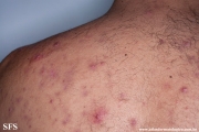 neutrophilic_eccrine_hidradenitis