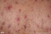 neutrophilic_eccrine_hidradenitis