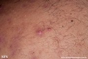 neutrophilic_eccrine_hidradenitis