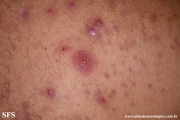 neutrophilic_eccrine_hidradenitis