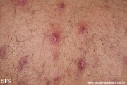 neutrophilic_eccrine_hidradenitis