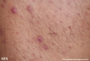 neutrophilic_eccrine_hidradenitis