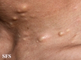 steatocystoma multiplex