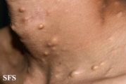 steatocystoma multiplex