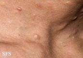 steatocystoma multiplex