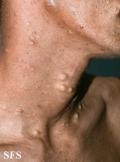 steatocystoma multiplex