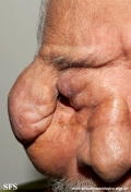steatocystoma multiplex