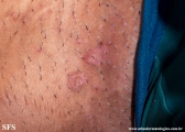 porokeratosis-inguinal_porokeratosis
