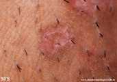 porokeratosis-inguinal_porokeratosis